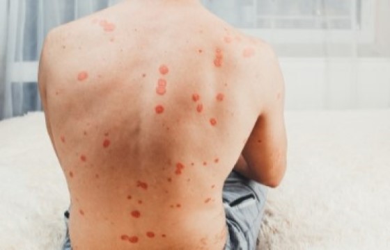 What causes Psoriasis?
