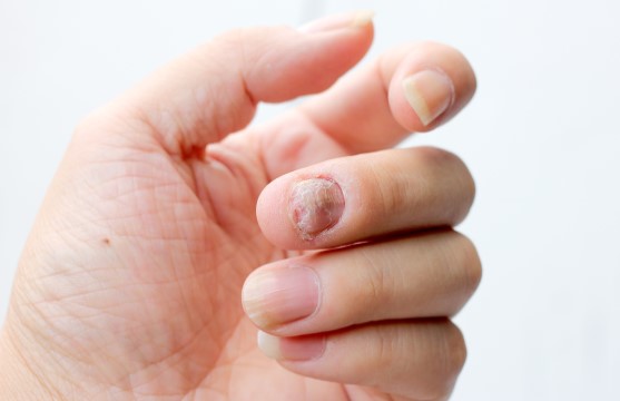 Psoriasis i naglar